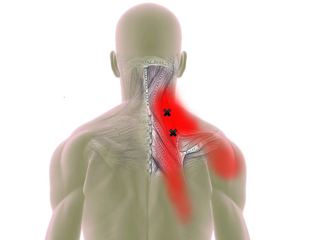 Триггерные точки. Симптомы, причины, лечение.