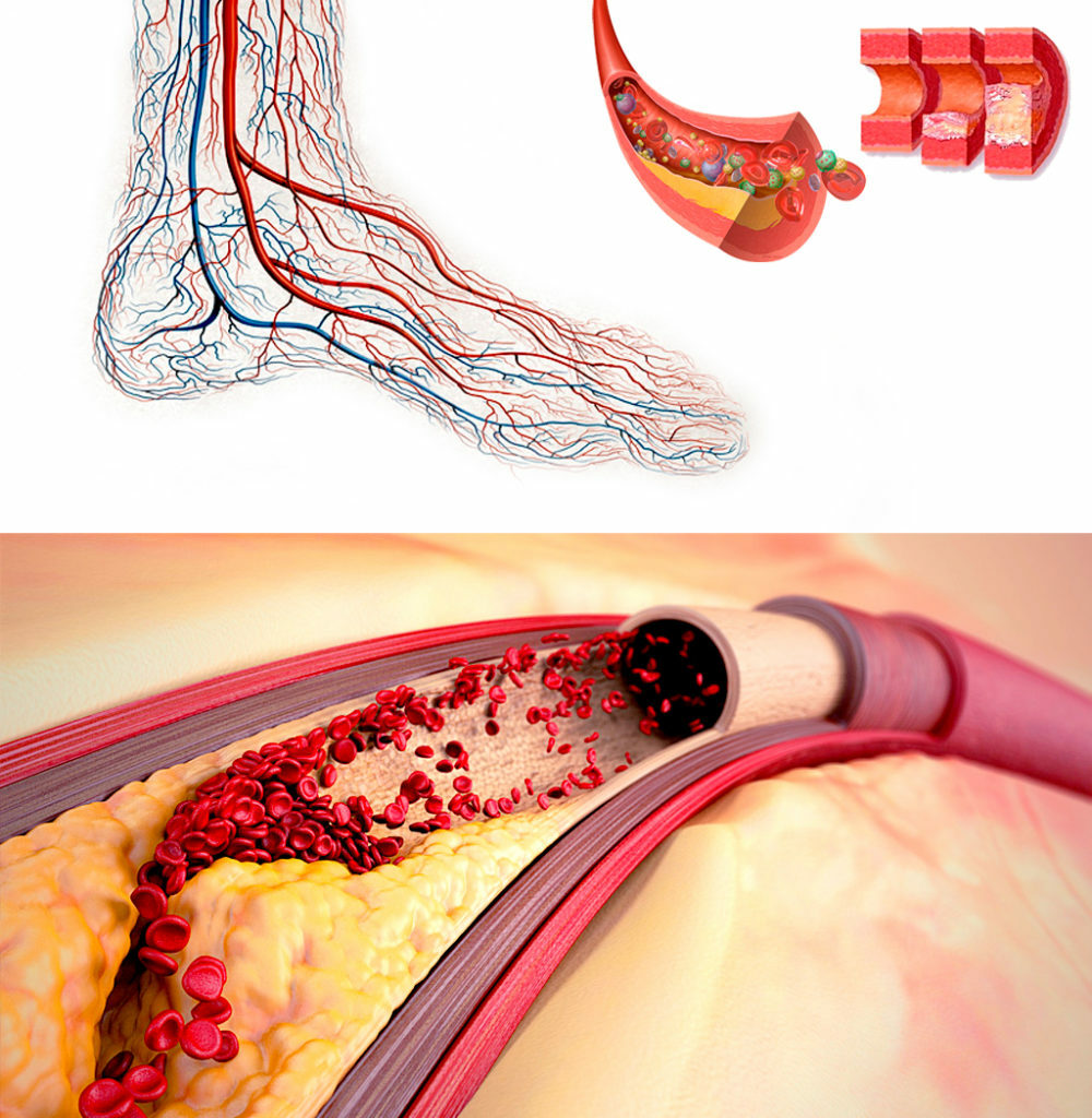 Повреждение мельчайших кровеносных сосудов. Менкеберга атеросклероз. Диабетическая макроангиопатия атеросклероз. Атеросклеротическое поражение кровеносных сосудов. Диабетическая ангиопатия нижних конечностей.