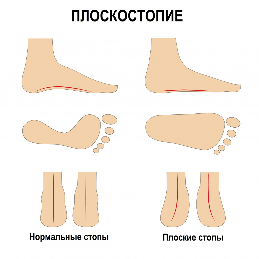 Плоскостопие у детей. Можно ли вылечить?